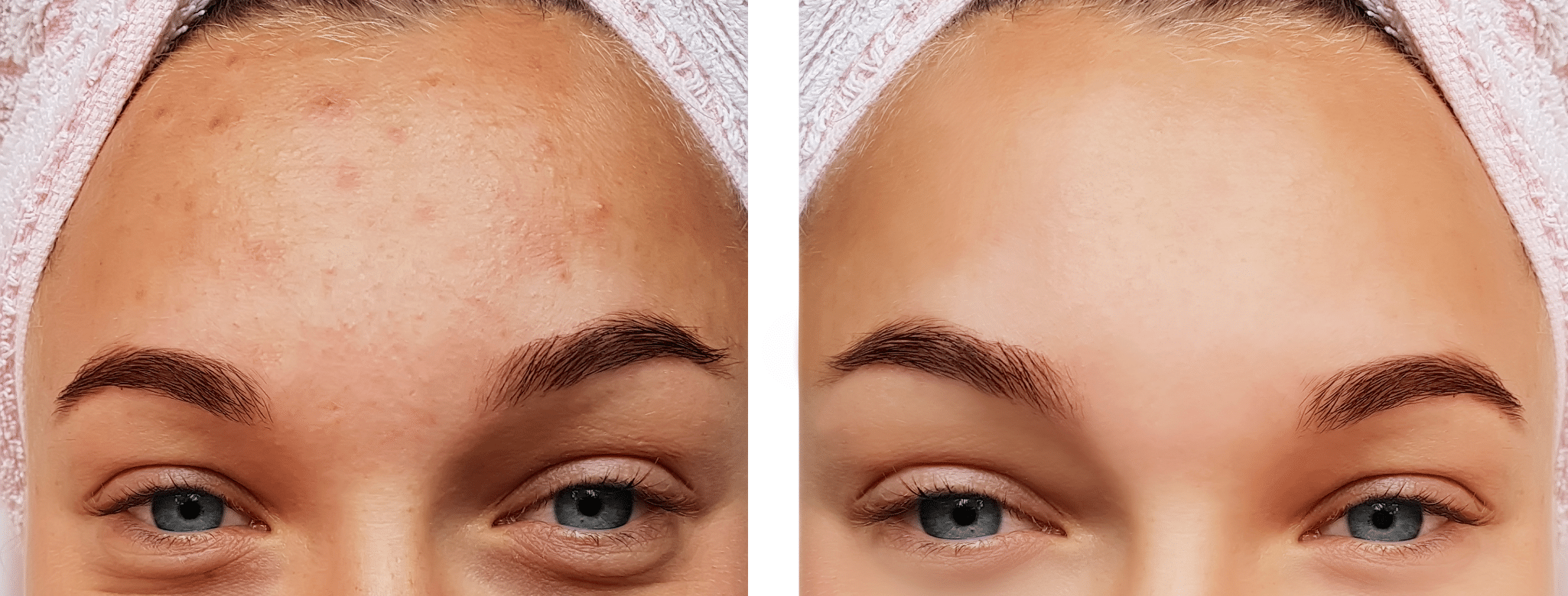 Rostro de una mujer antes y después del tratamiento de su acné con niacinamida: la niacinamida puede ayudar en el tratamiento del acné moderado.