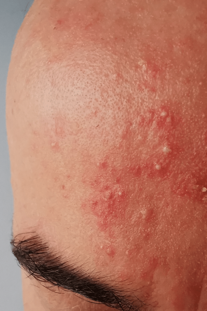 acne rosacea tratamiento