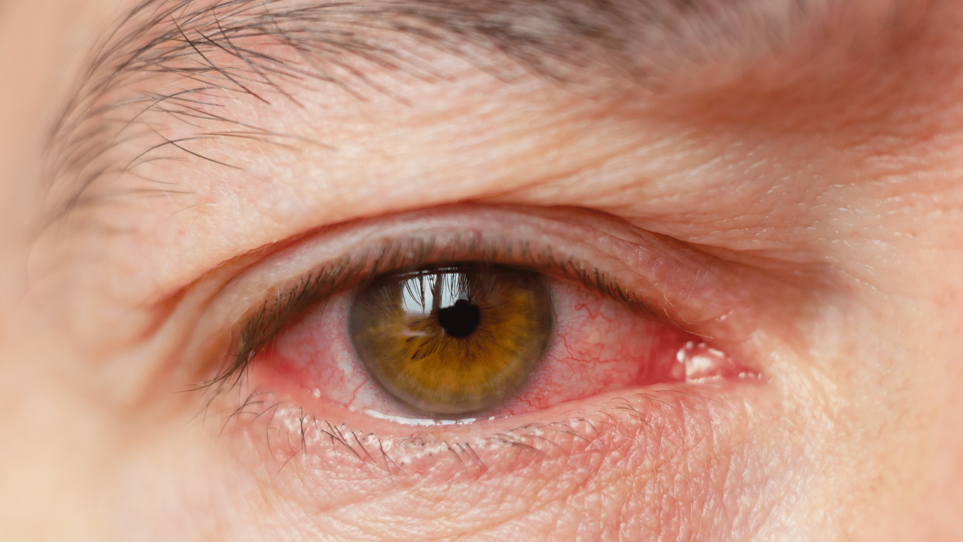 rosacea ocular sintomas