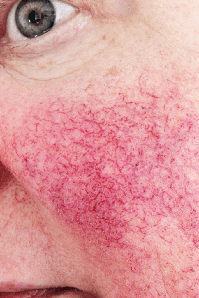 rosacea vascular