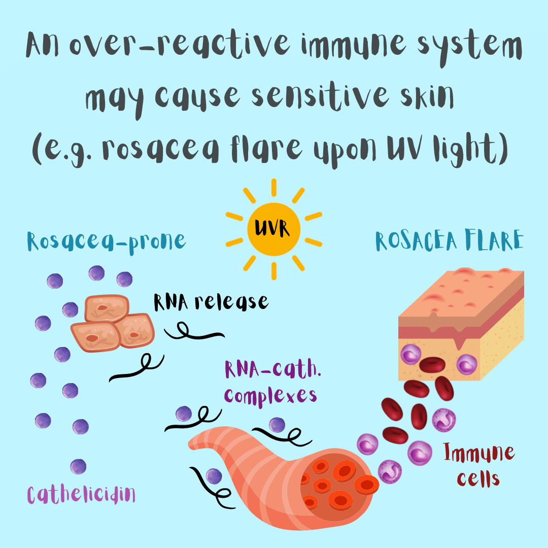 An over-reactive cutaneous immune system may cause sensitive skin (illustration of a rosacea flare upon UV light exposure as an example).