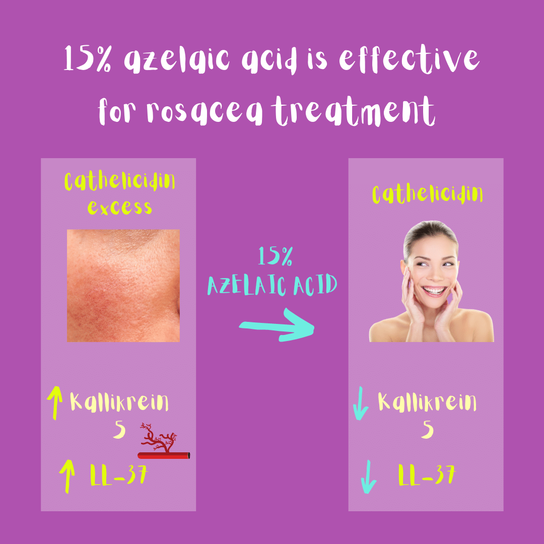 15% azelaic acid is effective for rosacea treatment: mechanism of action. Azelaic acid diminishes the amount of LL-37 (a small pepetide that worsens rosacea) in the skin.