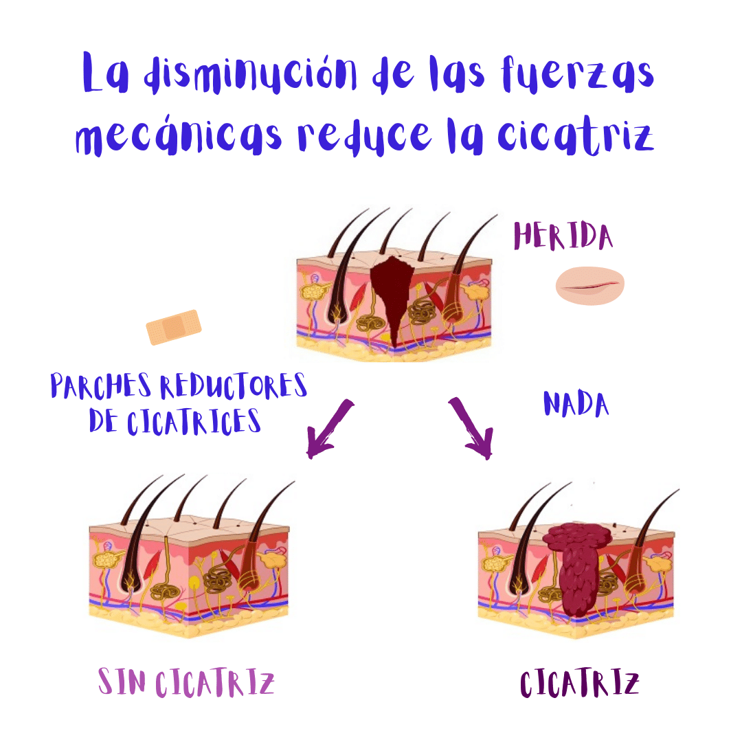 La disminución de las fuerzas mecánicas en el sitio de la lesión reduce la cicatriz (ilustración).