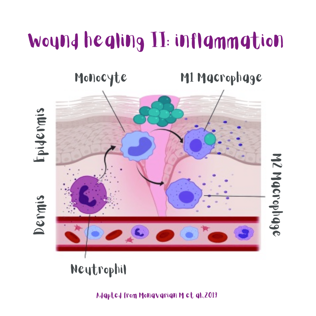 Stage 2 of skin wound healing: early and late inflammation (illustration). M1 macrophages and neutrophils get rid of bacteria and debris during the early pro-inflammatory phase. And M2 macrophages secrete anti-inflammatory molecules during the late phase of the inflammation stage.