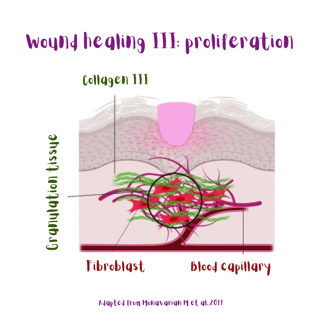 Stage III of skin wound healing: proliferation (illustration): the formation of granulation tissue takes place. Fibroblasts produce collagen type III at the site.