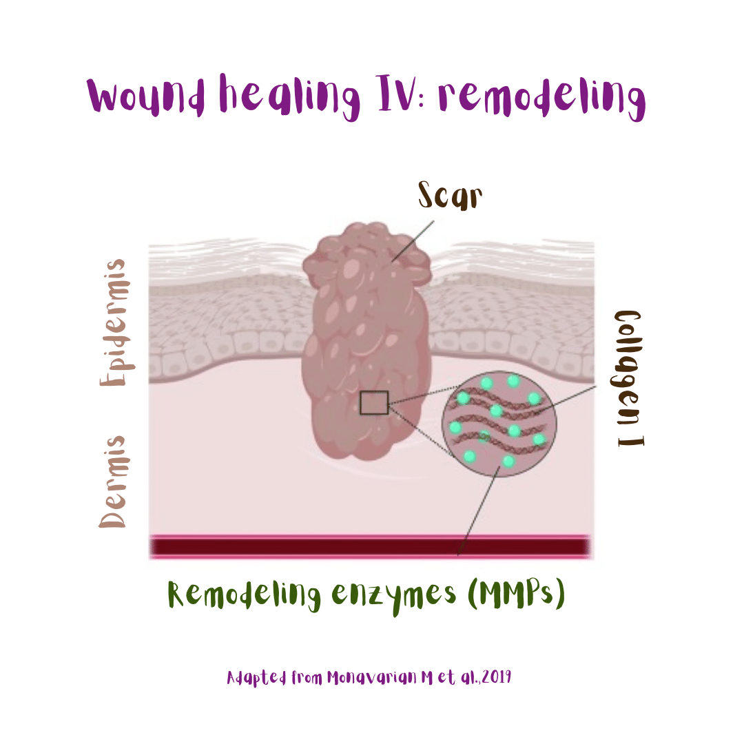 Skin wound healing stage IV: tissue remodeling (illustration). Remodeling enzymes (MMPs) work at the injury site and collagen III is replaced with collagen I. That results in the final scar.