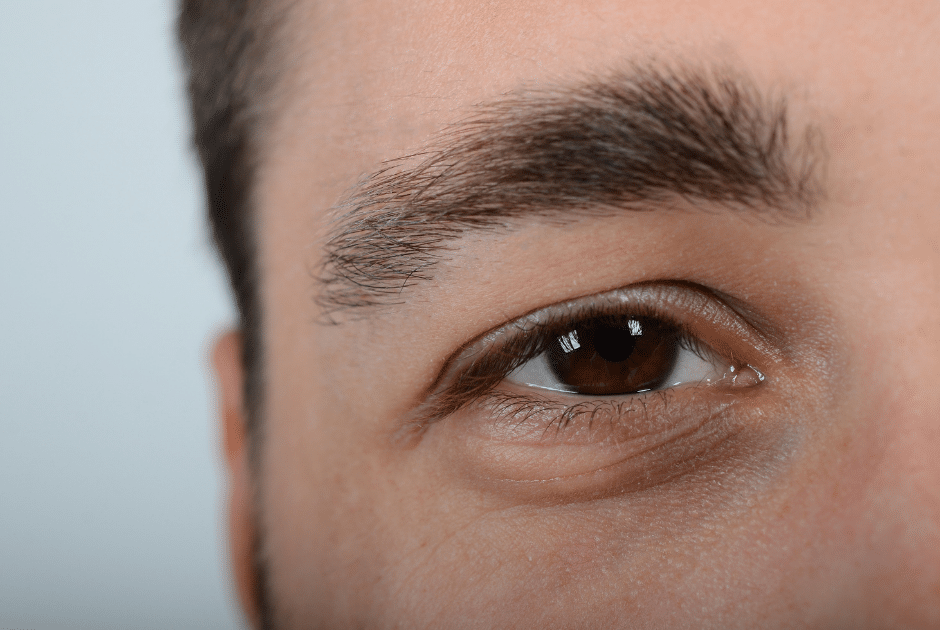Fotografía de un hombre con ojeras y bolsas alrededor de los ojos.