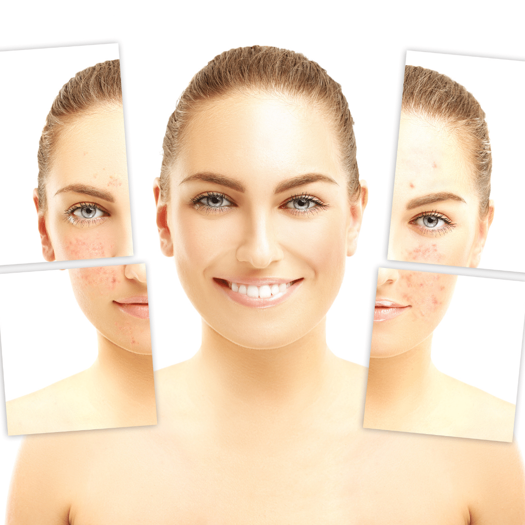 Photography of woman's face before and after a rosacea flare.