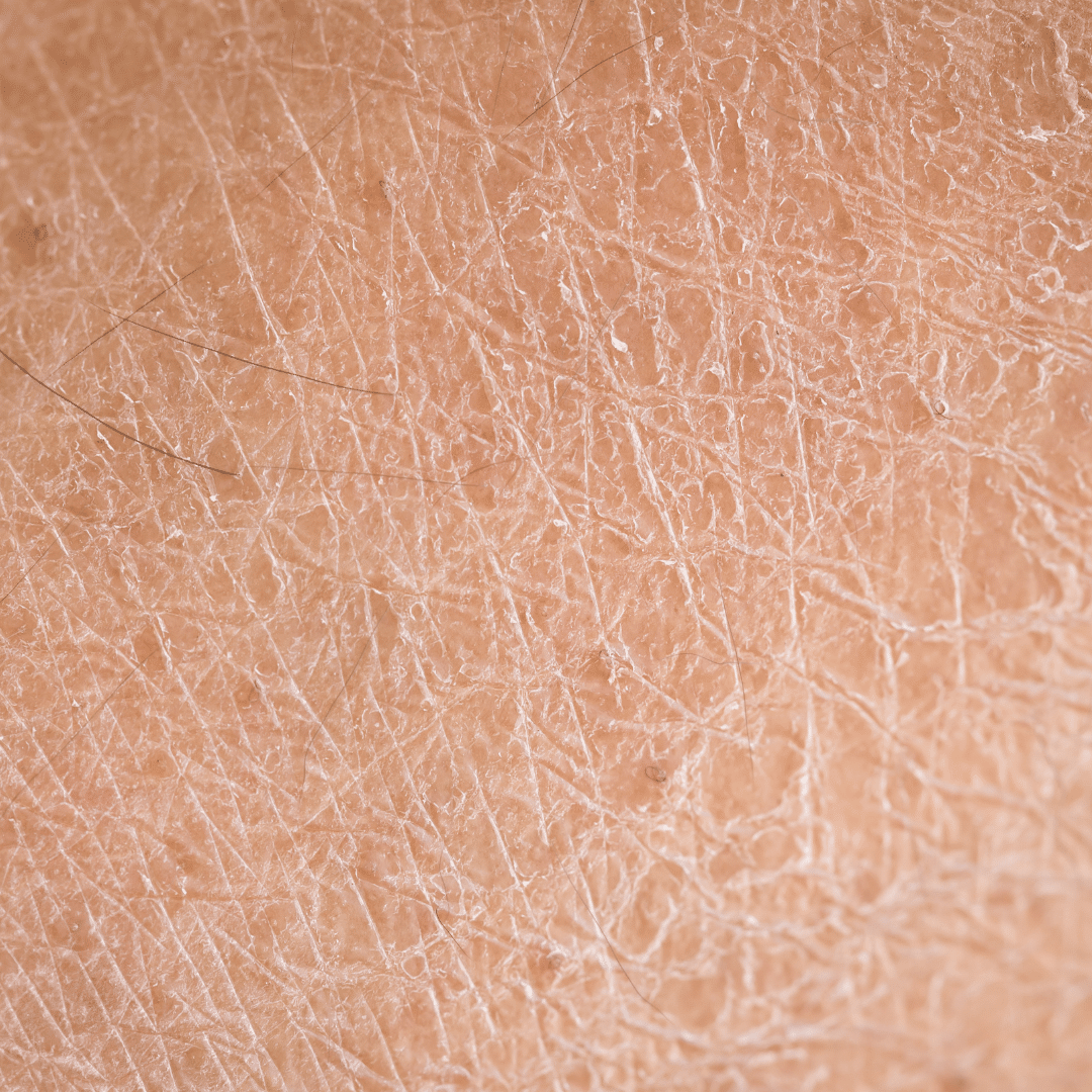 Mild ichthyosis vulgaris (the most common type of ichthyosis).