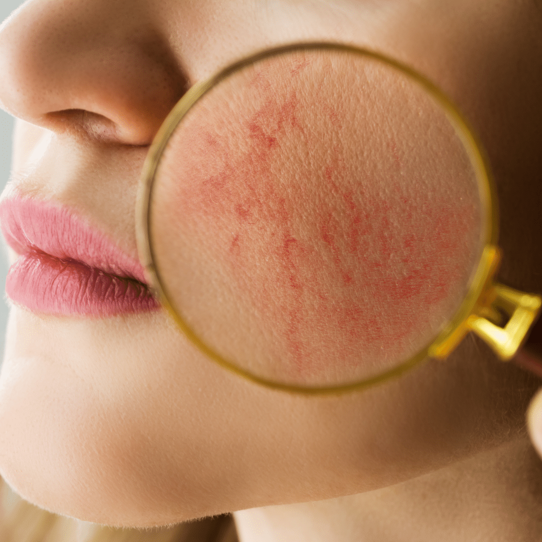 Photograph: cutaneous dilated blood vessels typical of vascular rosacea.