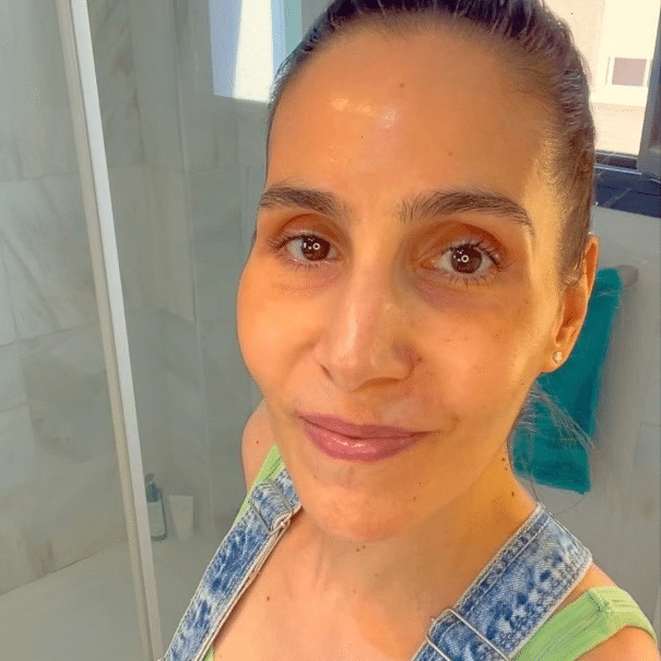 Picture of me with prominent dark circles and melasma as a result of postinflammatory hyperpigmentation in June 2022.