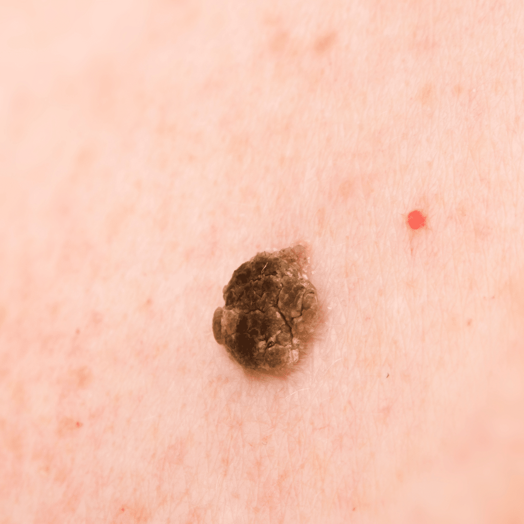Photograph: Seborrheic keratosis.