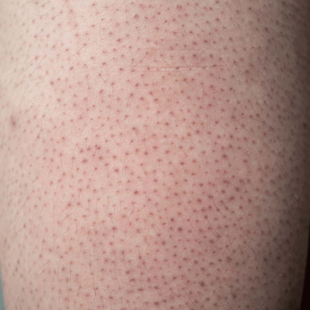 Strawberry skin (queratosis pilaris).