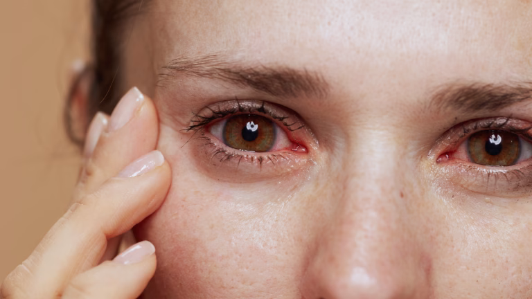 rosacea en los ojos