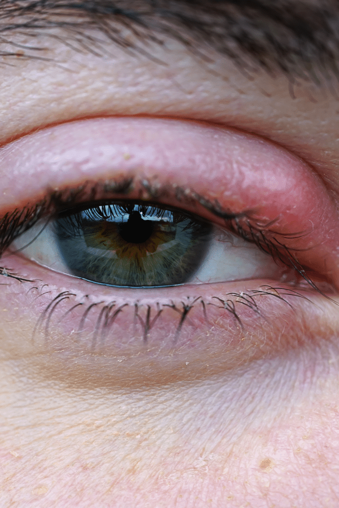 rosacea ocular fotos