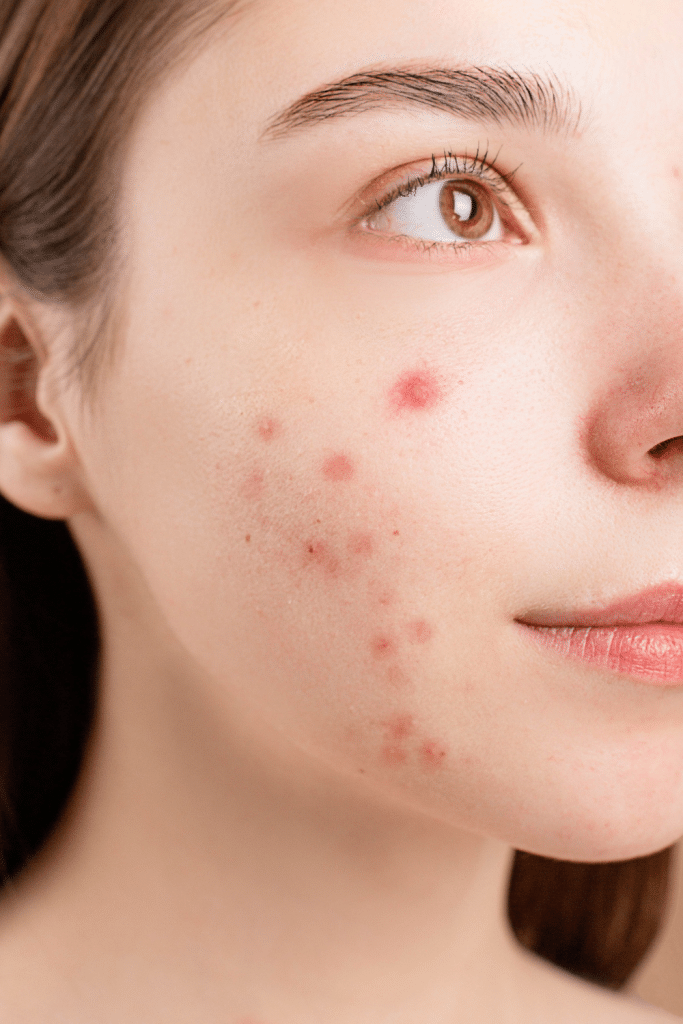 aloe vera acne