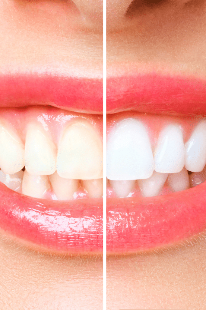 aloe vera para blanquear los dientes