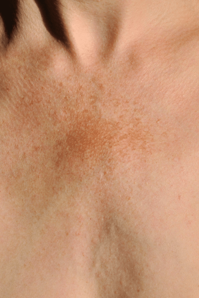 acido azelaico melasma