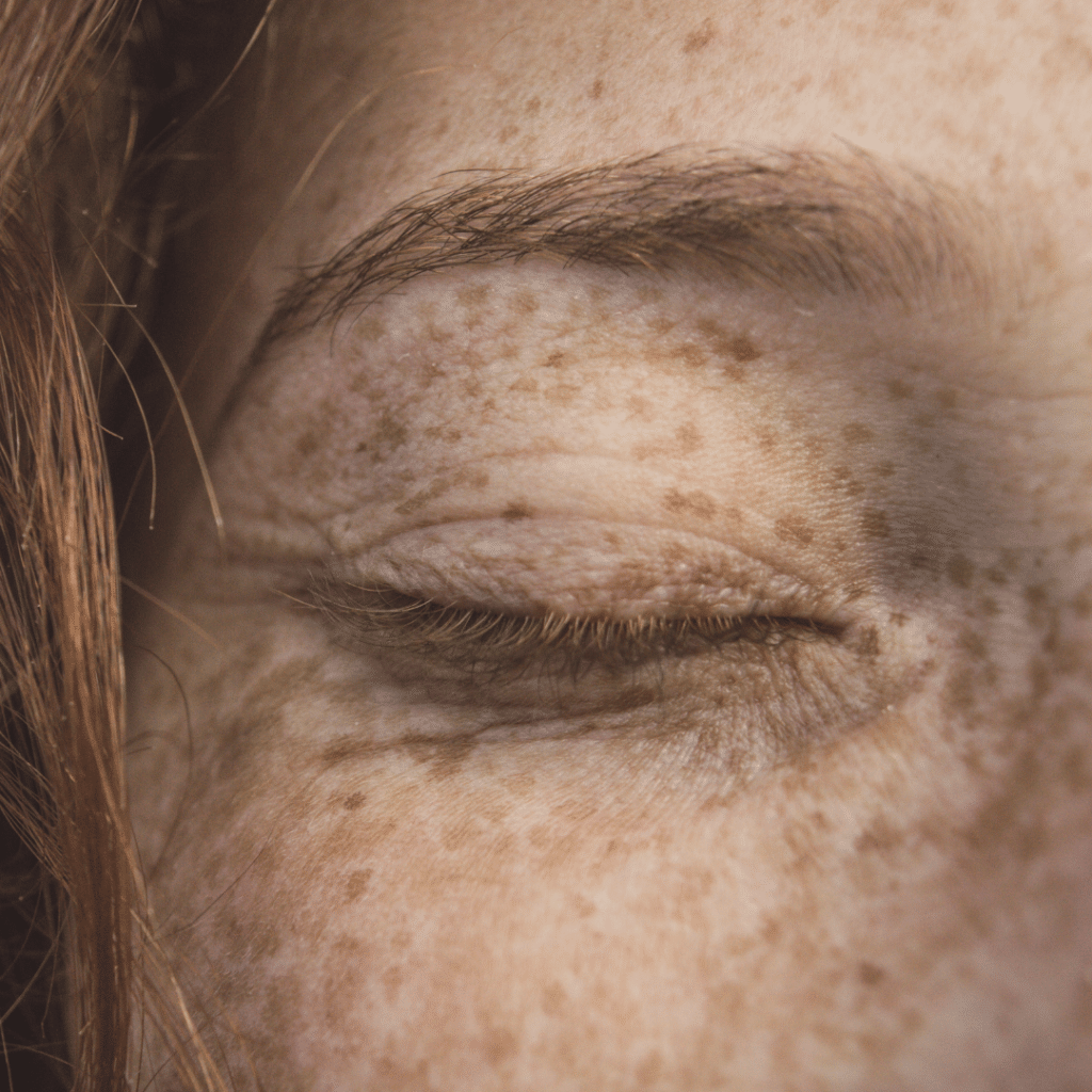 freckles the unlimited skin
