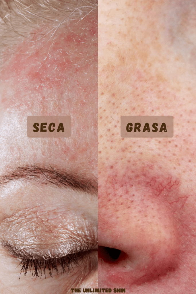 rosacea piel seca
