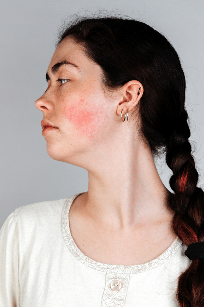 rosacea vascular