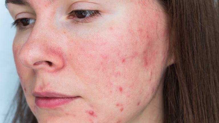 brote de rosacea