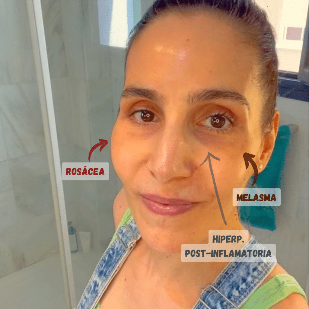 acido tranexamico ojeras