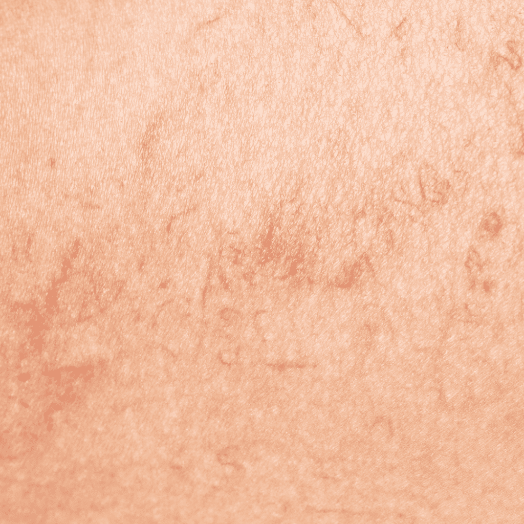 acido tranexamico rosacea