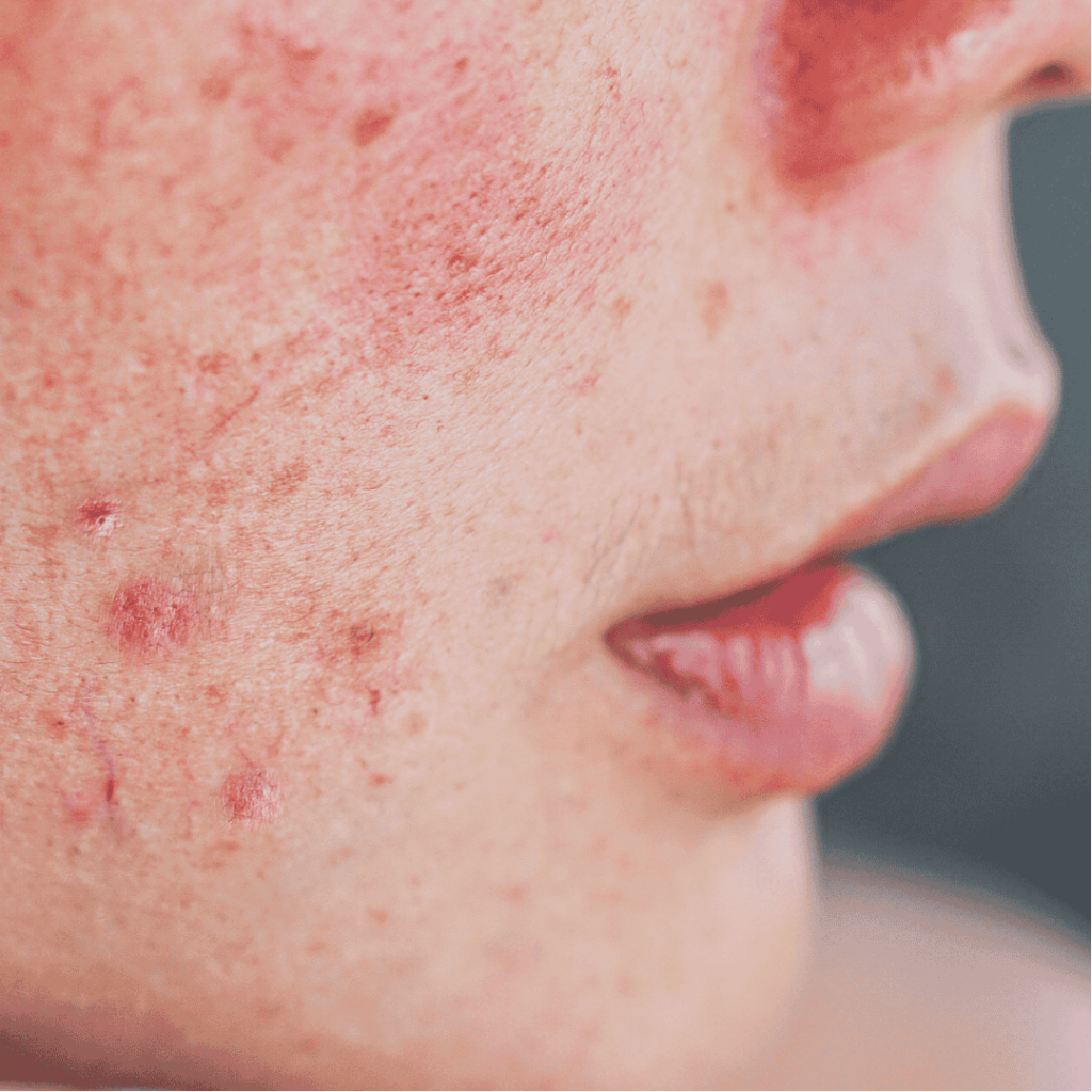 crema para rosacea y prevenir rojeces