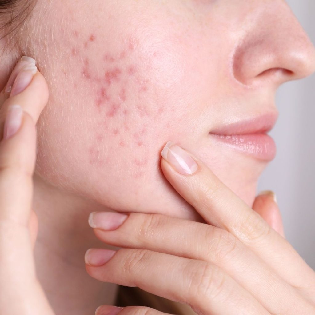 curcuma para acne