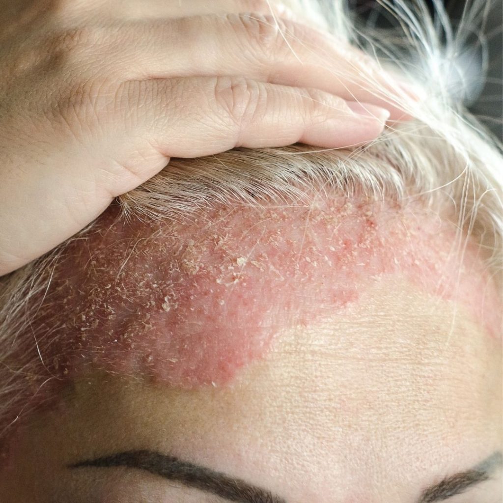 curcuma para la psoriasis