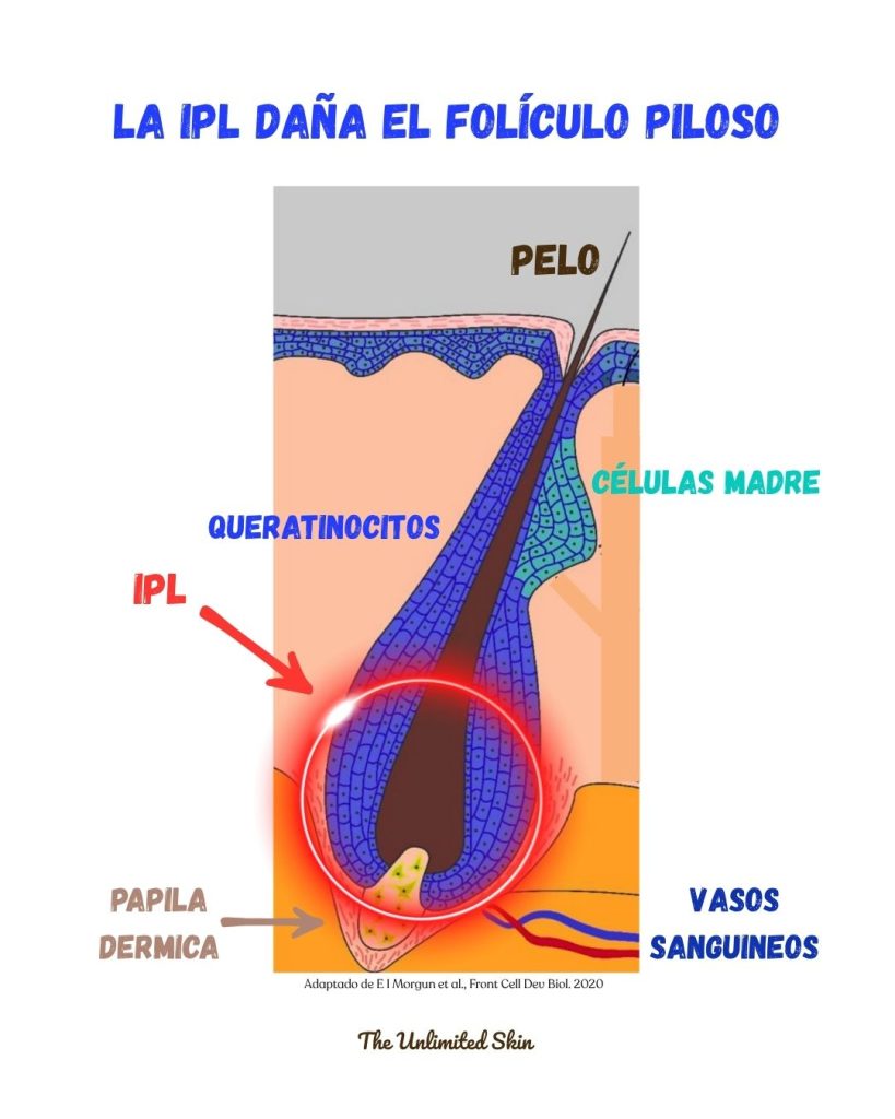 depilacion luz pulsada efectos secundarios
