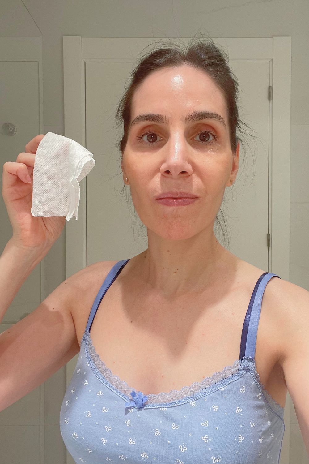 rosacea ocular tratamiento