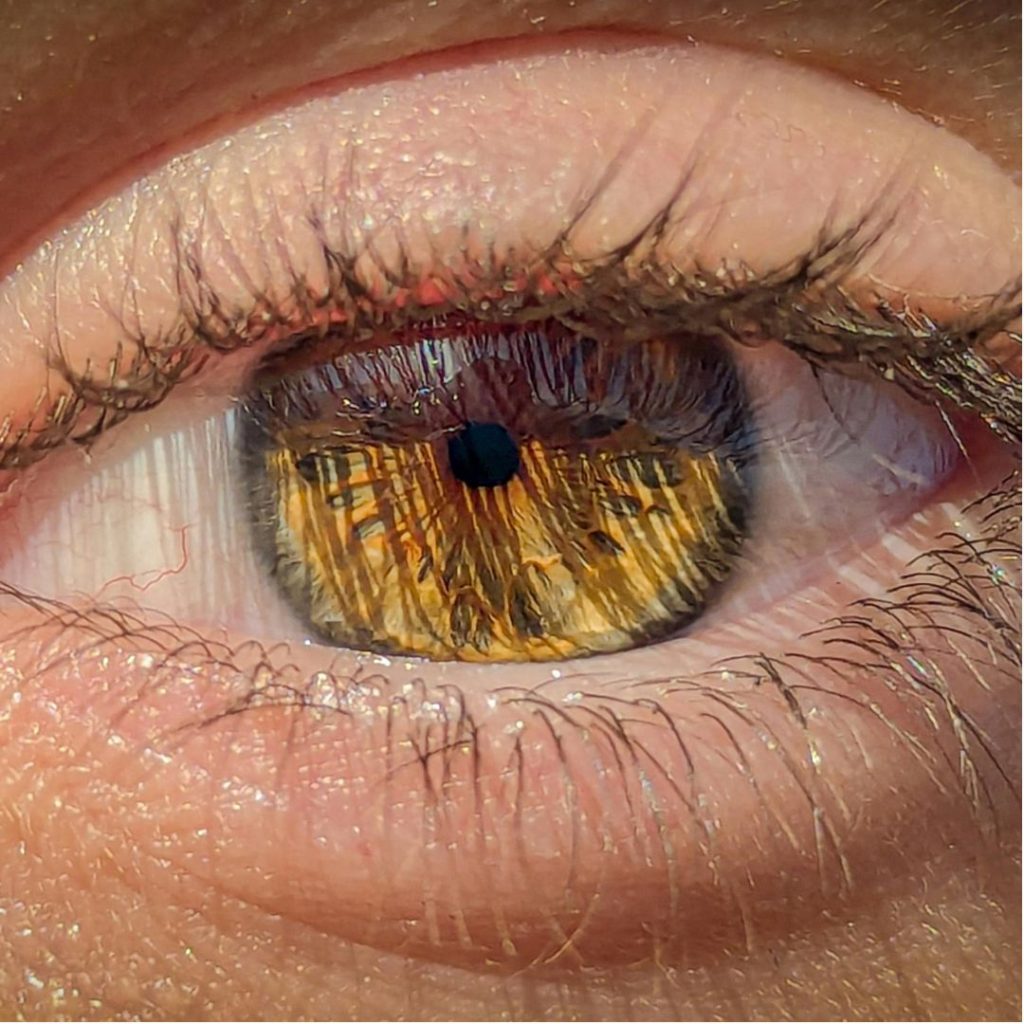 tratamiento rosacea ocular