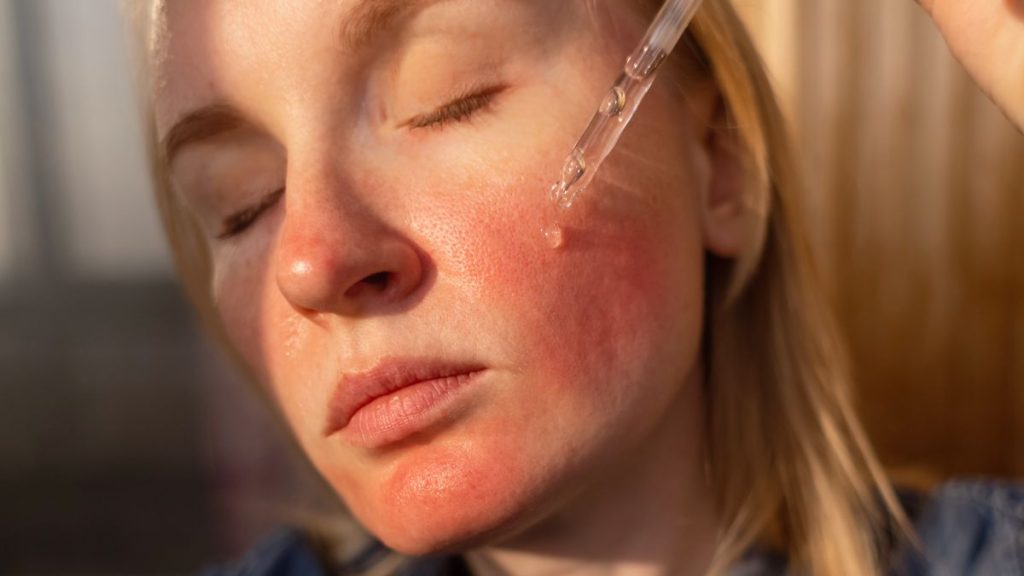 peeling para rosacea